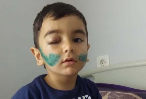 Üzünü it parçalayan uşağın SON DURUMU - Tikişlər sökülüb, üç gündən bir vaksinasiya olunur (FOTO)