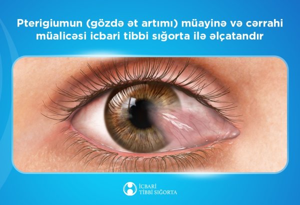 Ötən il ərzində icbari tibbi sığorta hesabına 2192 sayda gözdə ət artımı əməliyyatı icra olunub - Agentlik