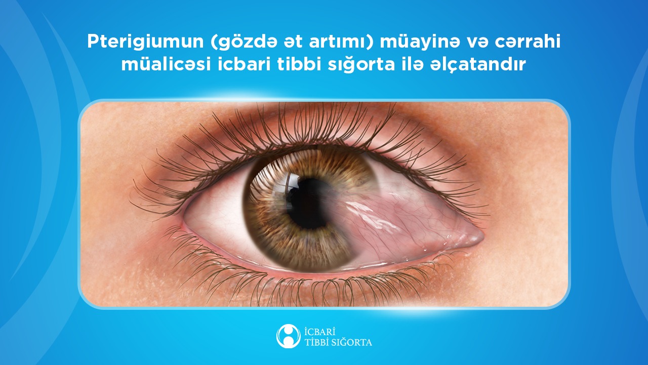 Ötən il ərzində icbari tibbi sığorta hesabına 2192 sayda gözdə ət artımı əməliyyatı icra olunub - Agentlik