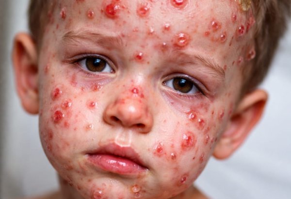 Suçiçəyi ilə bağlı narahatlıq – Səhiyyə Nazirliyindən açıqlama