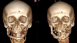Səhiyyə Nazirliyindən 10 saatlıq unikal əməliyyat: pasiyentin öz sümüyü ilə yeni çənə quruldu (FOTO/VİDEO)
