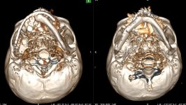 Səhiyyə Nazirliyindən 10 saatlıq unikal əməliyyat: pasiyentin öz sümüyü ilə yeni çənə quruldu (FOTO/VİDEO)