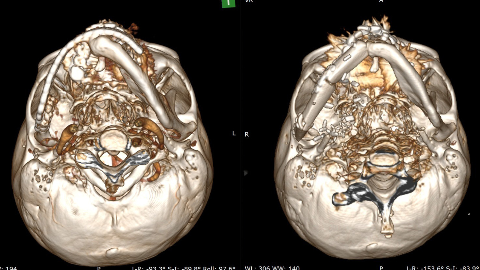 Səhiyyə Nazirliyindən 10 saatlıq unikal əməliyyat: pasiyentin öz sümüyü ilə yeni çənə quruldu (FOTO/VİDEO)