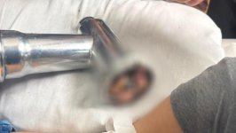 3 yaşlı uşağın ət maşınında ağır yaralanan əli 8 saatlıq əməliyyatla bərpa edilib (FOTO)